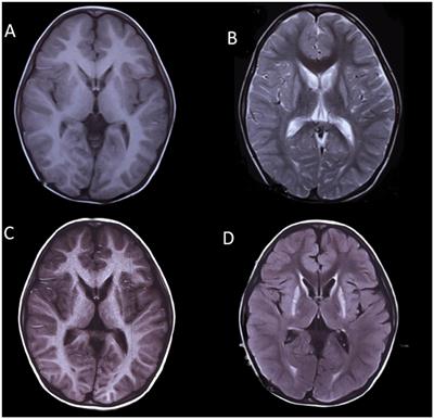 POLR3-related leukodystrophy caused by biallelic POLR3A and 1C pathogenic variants: a single-center experience